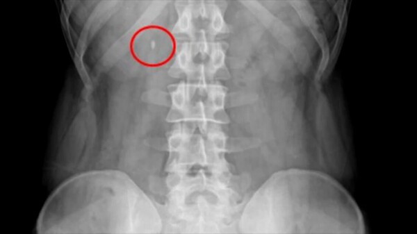 요로결석 엑스레이 (사진=연합뉴스)